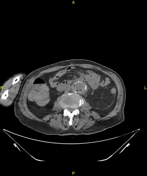 File:Aortoenteric fistula (Radiopaedia 84308-99603 Axial non-contrast 196).jpg