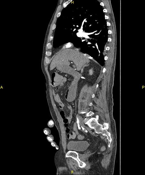 File:Aortoenteric fistula (Radiopaedia 84308-99603 C 136).jpg
