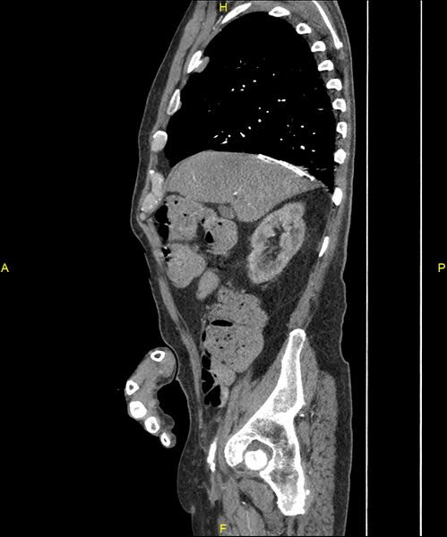 File:Aortoenteric fistula (Radiopaedia 84308-99603 C 96).jpg