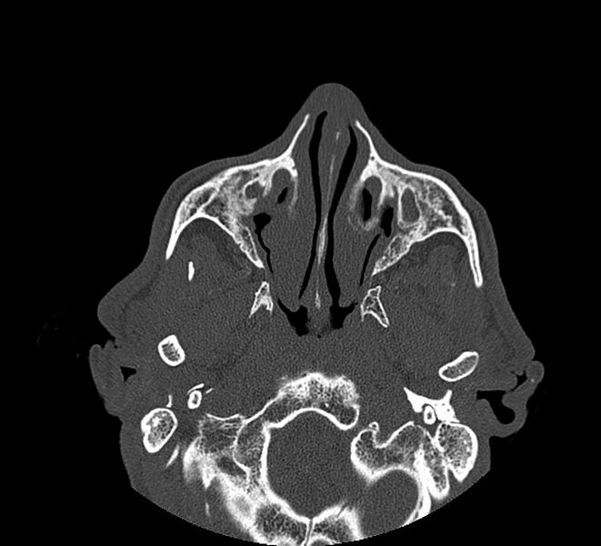 File:Aplastic maxillary sinuses (Radiopaedia 60030-67561 Axial non-contrast 29).jpg