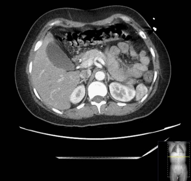File:Appendicitis (CT angiogram) (Radiopaedia 154713-127660 Axial 146).jpg