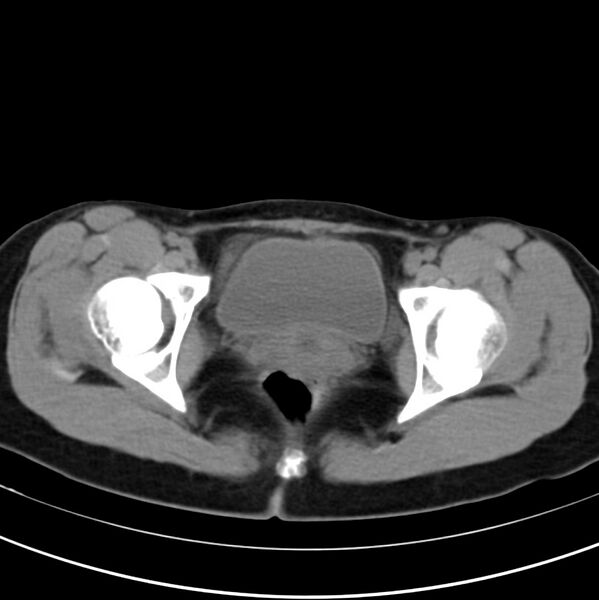 File:Appendicitis and incidental bicornuate uterus (Radiopaedia 22833-22853 Axial non-contrast 44).jpg