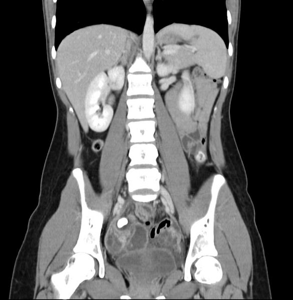 File:Appendicitis and incidental bicornuate uterus (Radiopaedia 22833-22853 D 25).jpg