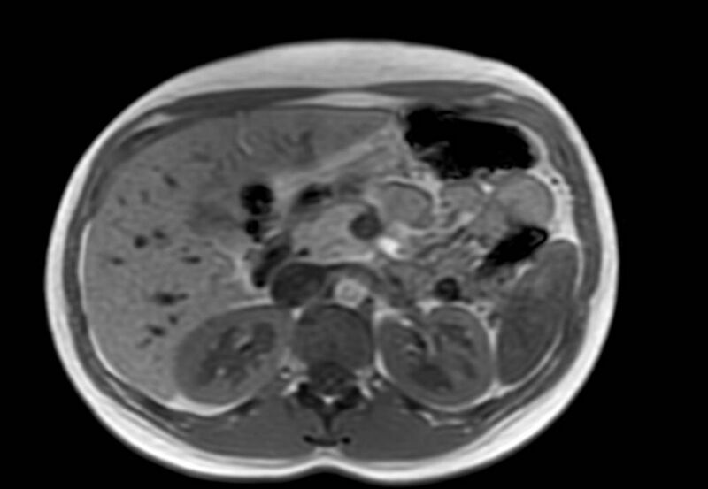 File:Appendicitis in gravida (MRI) (Radiopaedia 89433-106395 Axial T1 in-phase 19).jpg