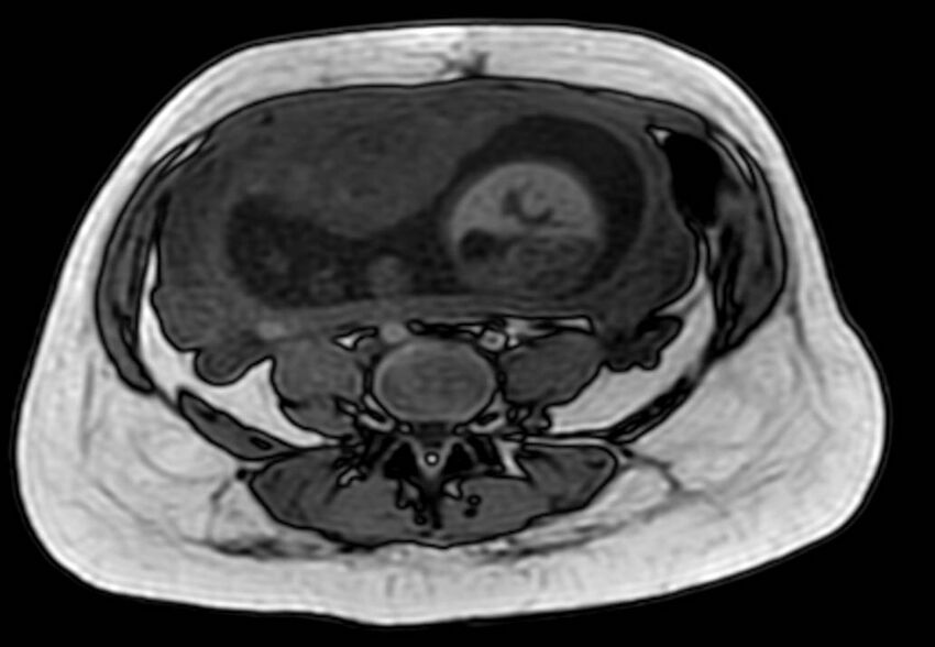 Appendicitis in gravida (MRI) (Radiopaedia 89433-106395 D 43).jpg