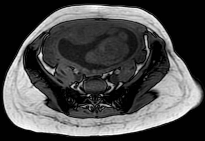 File:Appendicitis in gravida (MRI) (Radiopaedia 89433-106395 D 49).jpg