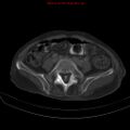 Arachnoiditis ossificans (Radiopaedia 51394-57136 Axial bone window 29).jpg