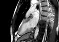 Arrhythmogenic right ventricular cardiomyopathy (Radiopaedia 39806-42237 B 16).jpg
