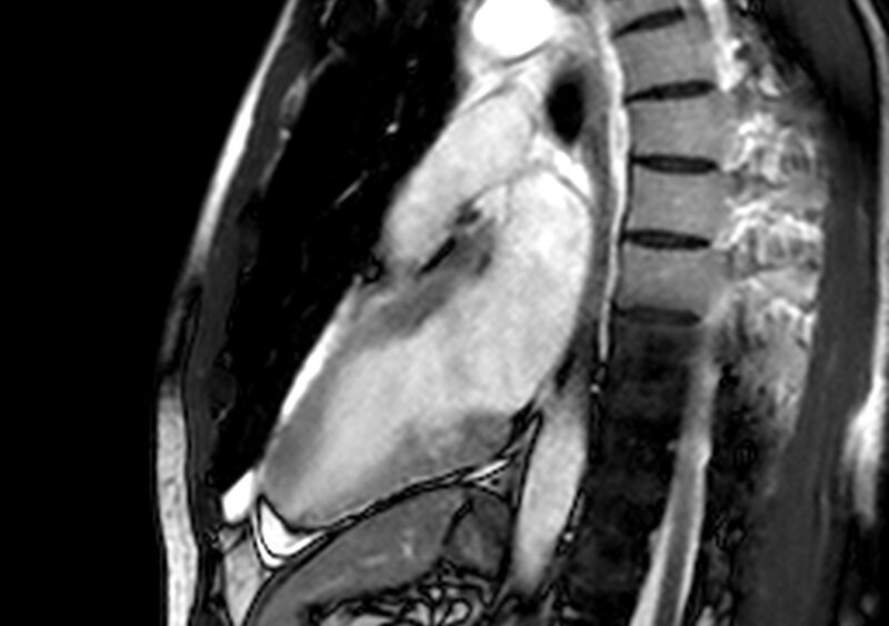 File:Arrhythmogenic right ventricular cardiomyopathy (Radiopaedia 39806-42237 B 16).jpg