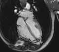 Arrhythmogenic right ventricular cardiomyopathy (Radiopaedia 39806-42237 D 40).jpg