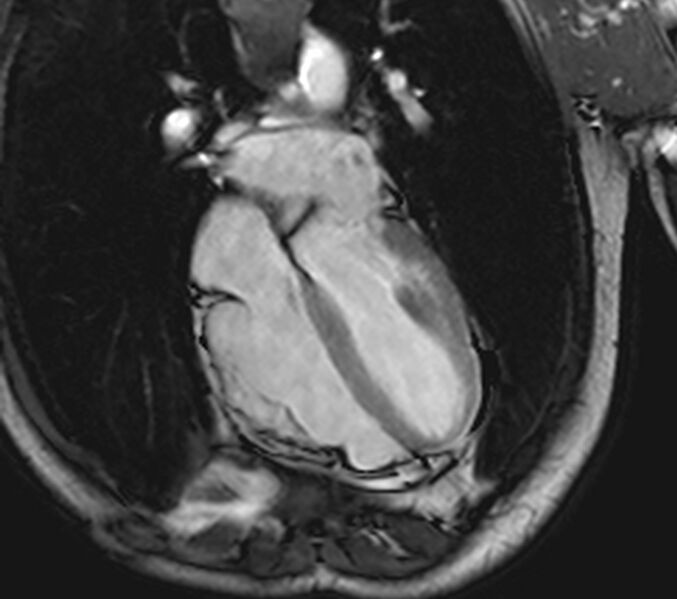 File:Arrhythmogenic right ventricular cardiomyopathy (Radiopaedia 39806-42237 D 40).jpg
