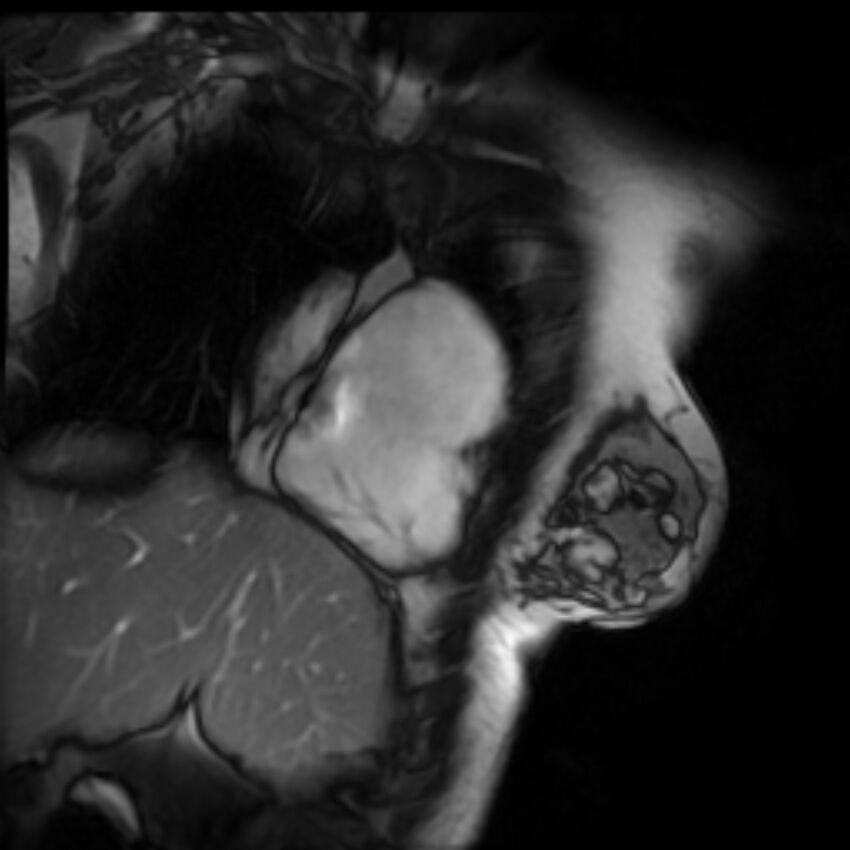 Arrhythmogenic right ventricular cardiomyopathy (Radiopaedia 87505-103850 2ch (RV) Cine SSFP 42).jpg