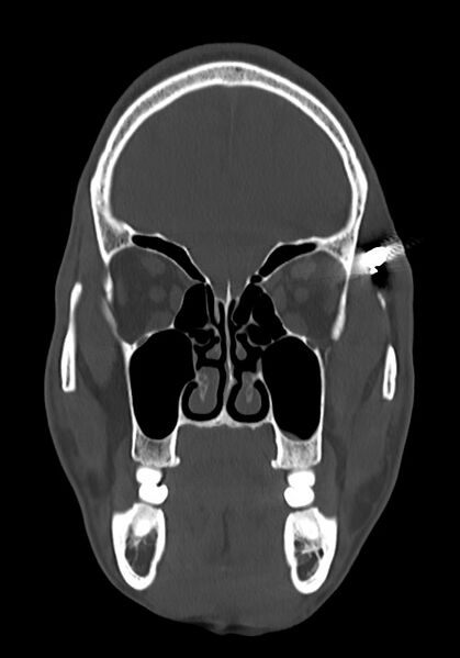 File:Arrow injury to the head (Radiopaedia 75266-86388 Coronal bone window 32).jpg