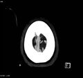 Arteriovenous malformation - cerebral (Radiopaedia 8172-14682 A 17).jpg