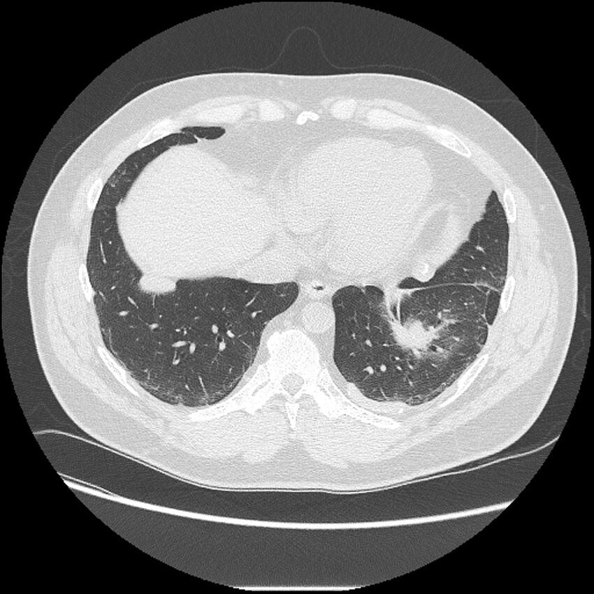 Asbestosis (Radiopaedia 45002-48961 Axial lung window 37).jpg