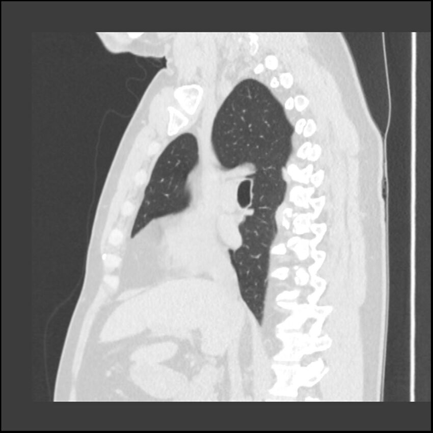 Asbestosis (Radiopaedia 45002-48961 Sagittal lung window 77).jpg
