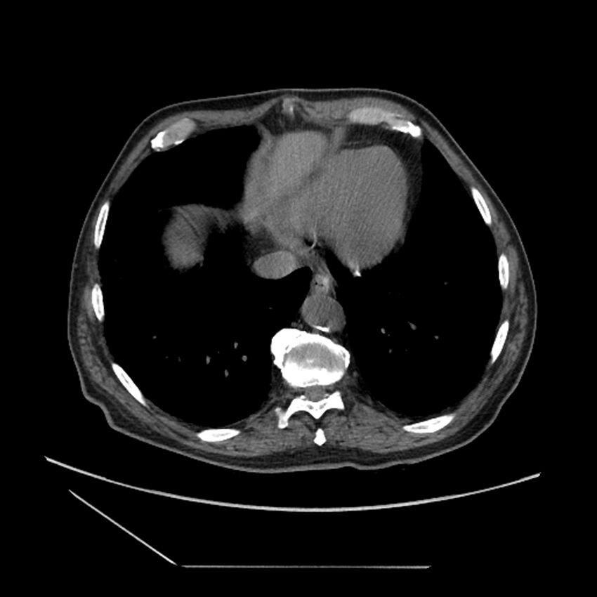 Asbestosis complicated by lung cancer (Radiopaedia 45834-50116 Axial non-contrast 51).jpg