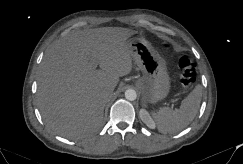 File:Ascending aortic aneurysm (Radiopaedia 86279-102297 C 64).jpg