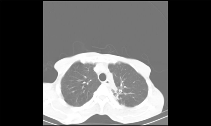 File:Aspergilloma (Radiopaedia 20788-20701 Axial lung window 9).jpg
