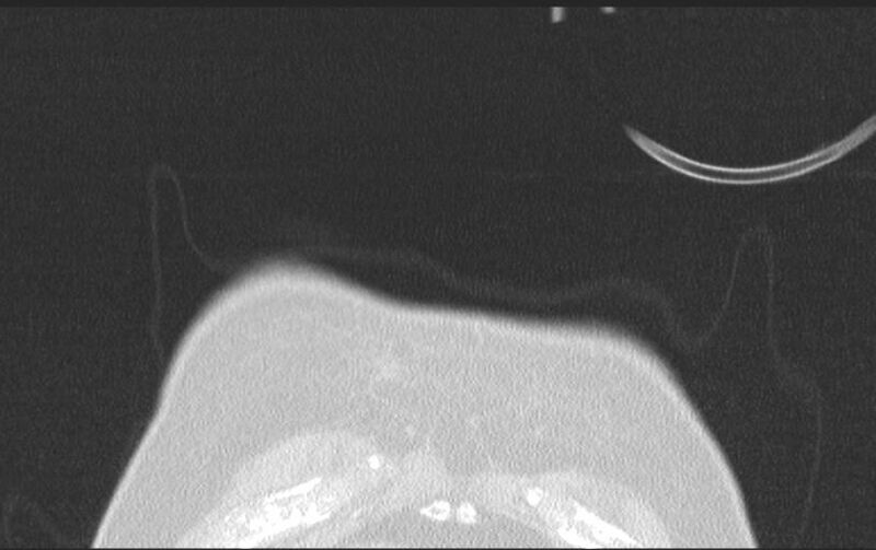 File:Aspirated tooth (Radiopaedia 28584-28844 Axial lung window 15).jpg