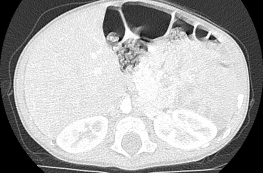 Asplenia syndrome (Radiopaedia 73083-83792 Axial lung window 86).jpg