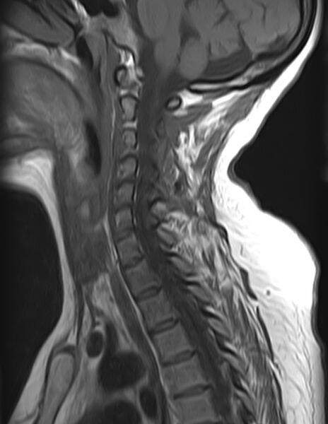 File:Astrocytoma - spinal cord (Radiopaedia 69769-79758 Sagittal T1 8).jpg