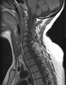Astrocytoma - spinal cord (Radiopaedia 69769-79758 Sagittal T1 8).jpg