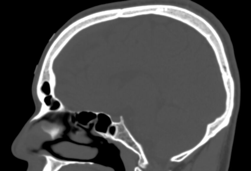 Asymptomatic occipital spur (Radiopaedia 87753-104201 Sagittal bone window 140).jpg