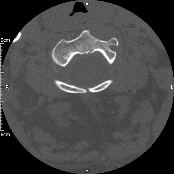File:Atlas fracture with Currarino type A congenital defect (Radiopaedia 71747-82144 Axial bone window 53).jpg