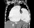 Atrial septal defect complicated by Eisenmenger syndrome (Radiopaedia 53707-59768 Coronal C+ CTPA 8).jpg