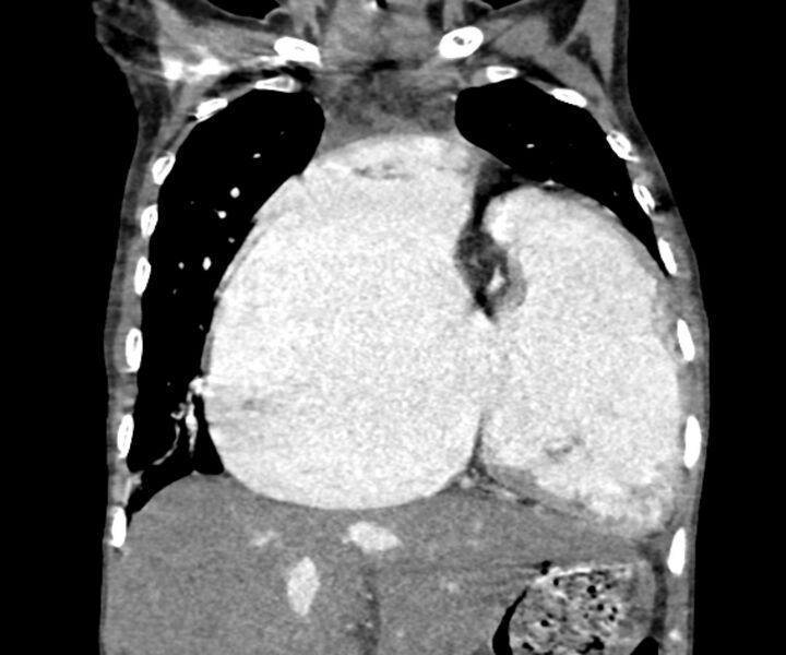 File:Atrial septal defect complicated by Eisenmenger syndrome (Radiopaedia 53707-59768 Coronal C+ CTPA 8).jpg
