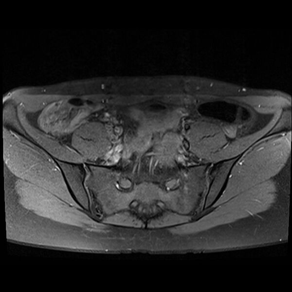File:Atypical deep infiltrating endometriosis (Radiopaedia 44470-48125 Axial T1 fat sat 3).jpg