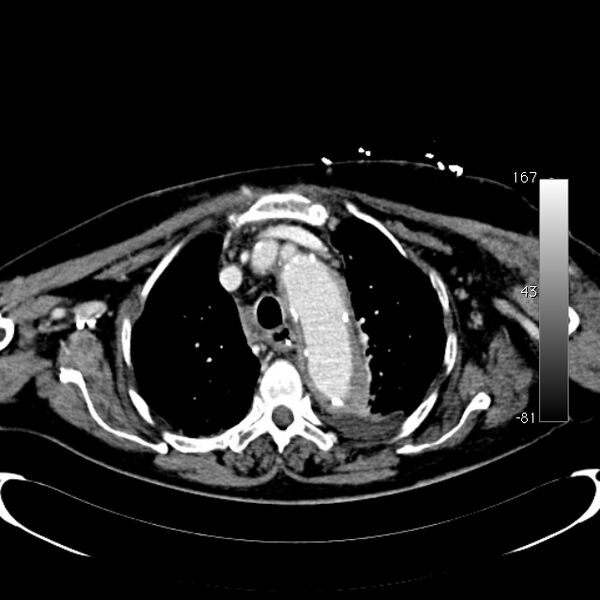 File:Atypical dissection of the thoracic aorta (Radiopaedia 10975-78320 A 12).jpg