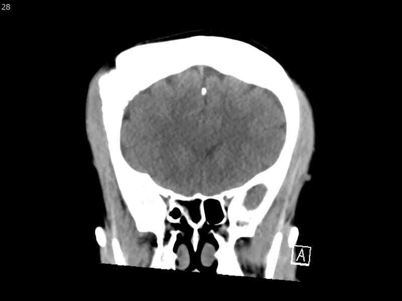 File:Atypical meningioma - intraosseous (Radiopaedia 64915-73867 B 27).jpg