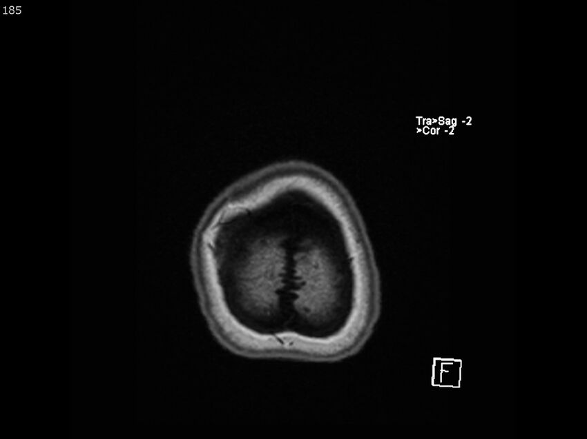 Atypical meningioma - intraosseous (Radiopaedia 64915-74572 Axial T1 185).jpg