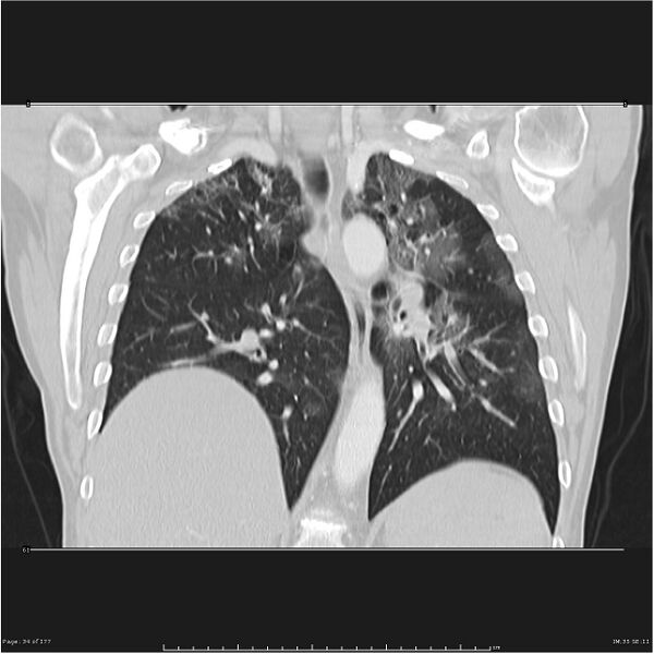 File:Atypical pneumonia - Q fever (Radiopaedia 21993-21989 C 27).jpg