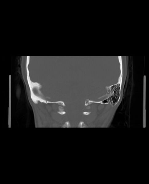 File:Automastoidectomy with labyrinthine fistula (Radiopaedia 84143-99411 Coronal non-contrast 114).jpg