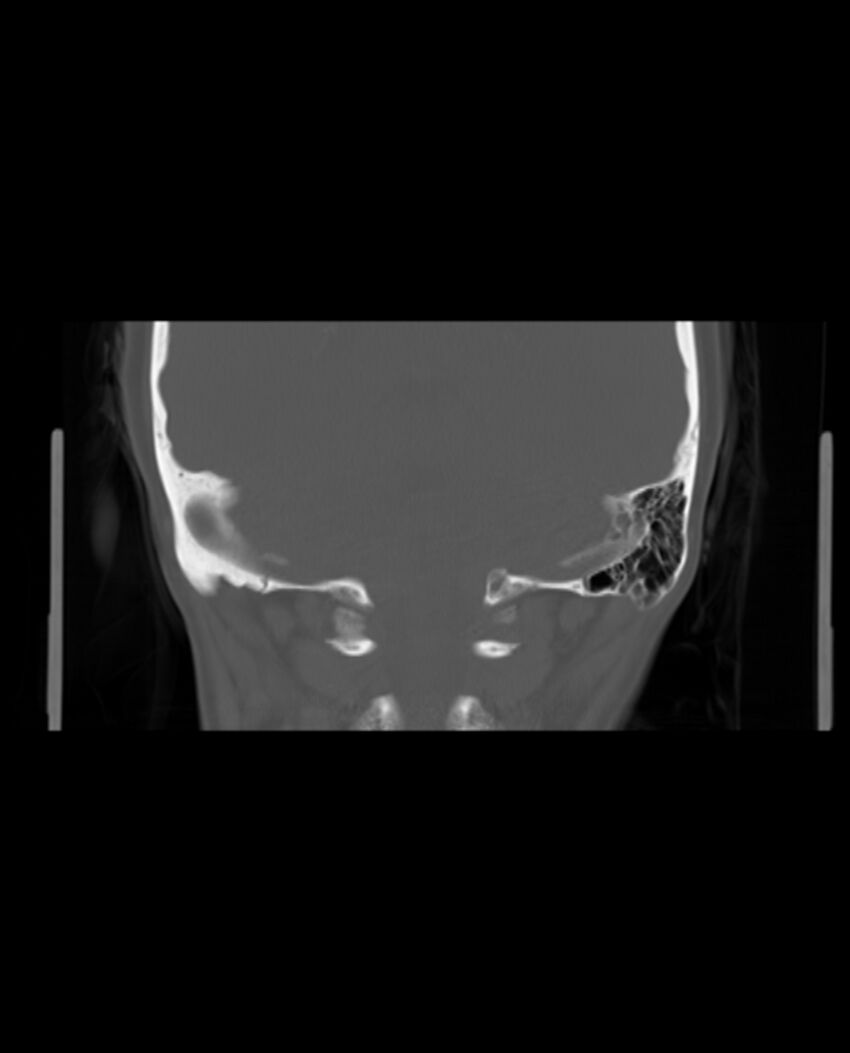Automastoidectomy with labyrinthine fistula (Radiopaedia 84143-99411 Coronal non-contrast 114).jpg