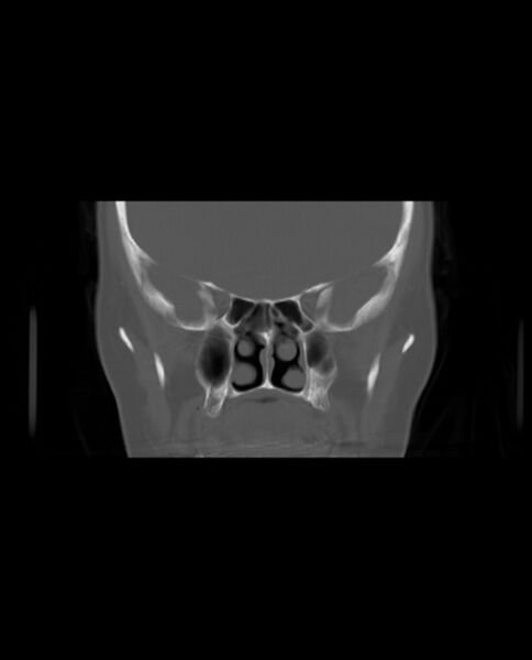 File:Automastoidectomy with labyrinthine fistula (Radiopaedia 84143-99411 Coronal non-contrast 49).jpg