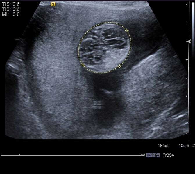File:Autosomal recessive polycystic kidney disease -antenatal. (Radiopaedia 66807).jpg