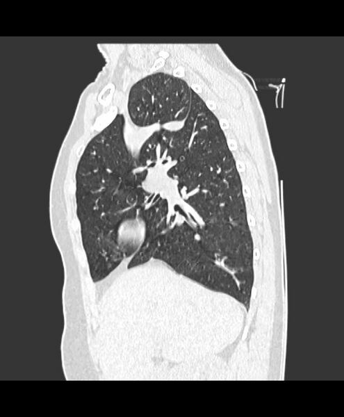 File:Azygos fissure and azygos lobe (Radiopaedia 41841-44832 Sagittal lung window 5).jpg