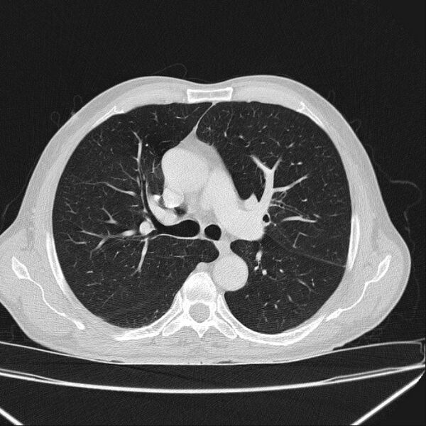 File:Azygos lobe (Radiopaedia 38259-40275 Axial lung window 33).jpg