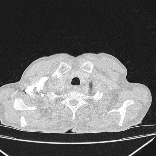 File:Azygos lobe (Radiopaedia 38259-40275 Axial lung window 4).jpg