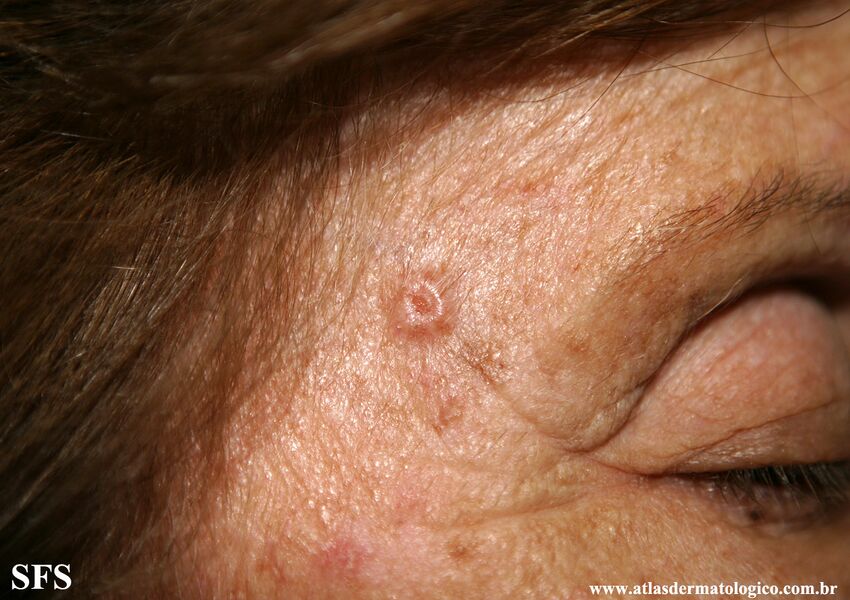 Basal Cell Carcinoma (Dermatology Atlas 348).jpg