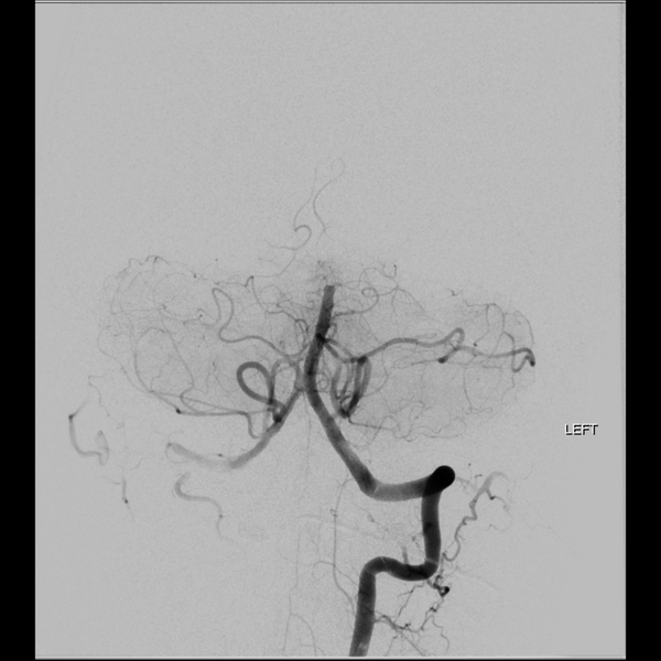 File:Basilar tip thrombus with endovascular clot retrieval (Radiopaedia 46320-50726 B 10).png