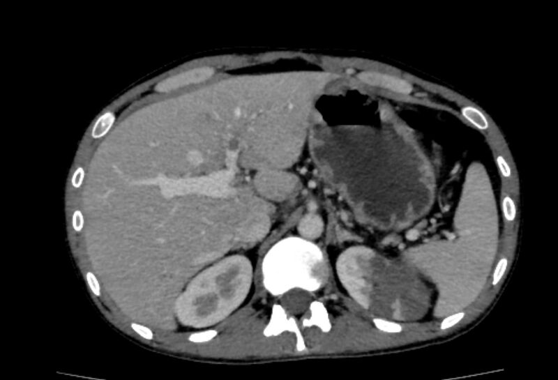 File:Behçet's disease- abdominal vasculitis (Radiopaedia 55955-62570 A 16).jpg
