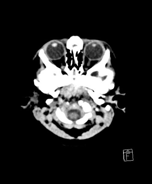 File:Benign enlargement of subarachnoid spaces in infancy (BESS) (Radiopaedia 87459-103795 Axial non-contrast 79).jpg