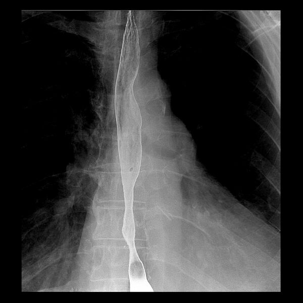 File:Benign esophageal stricture - post reflux (Radiopaedia 75592-86878 D 1).jpg