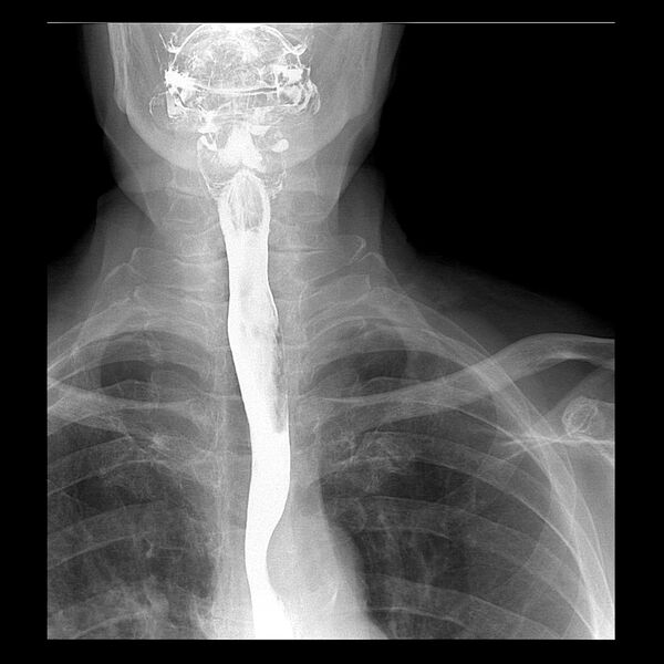 File:Benign esophageal stricture - post reflux (Radiopaedia 75592-86878 Frontal 1).jpg
