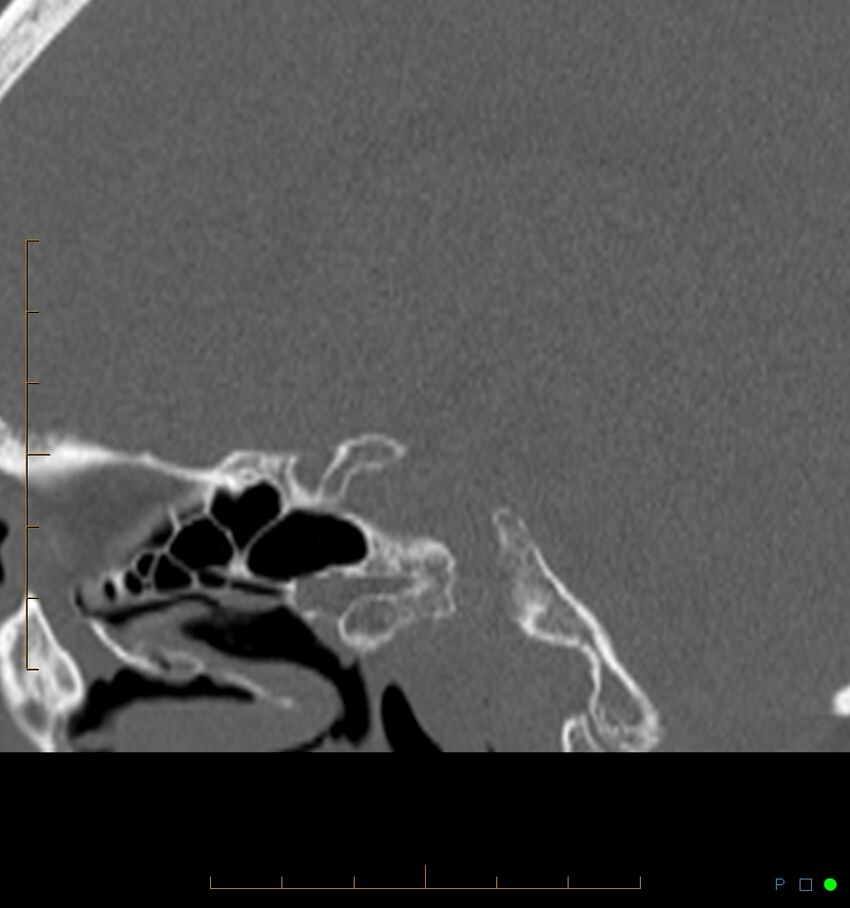 Benign notochordal cell tumor (probable) (Radiopaedia 65475-74546 Sagittal bone window 8).jpg